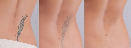 Лазерное удаление татуировок по методу «шовной строчки»